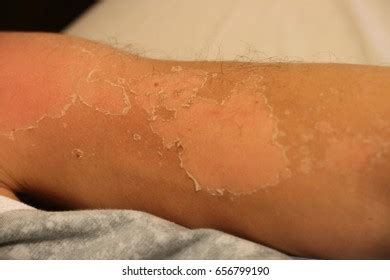 251 Severe Sunburn Images, Stock Photos & Vectors | Shutterstock