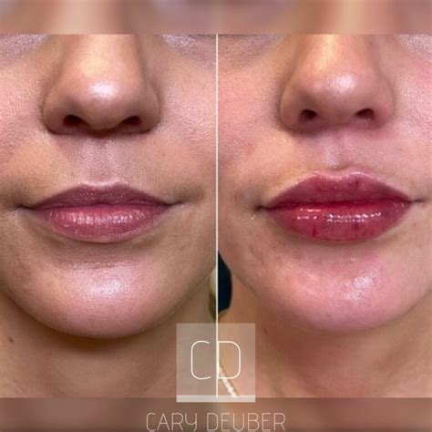 cary lip filler  lemmon avenue plastic surgery laser center dr