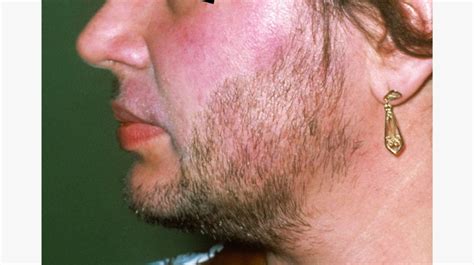 women facial hair steroids