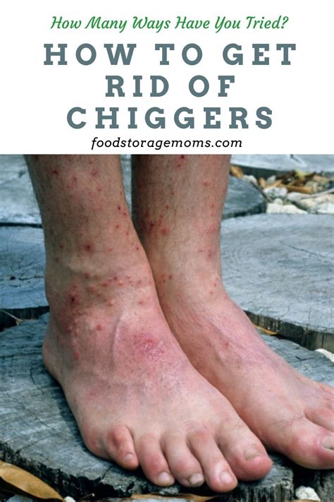 How to Get Rid of Chiggers | Chigger bites, Chigger bite remedy ...