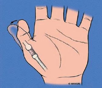 Stenosing Tenosynovitis Trigger Finger Causes - madathos