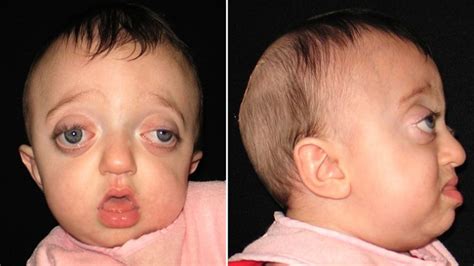 Pfeiffer Syndrome Causes, Symptoms, and Treatment Options
