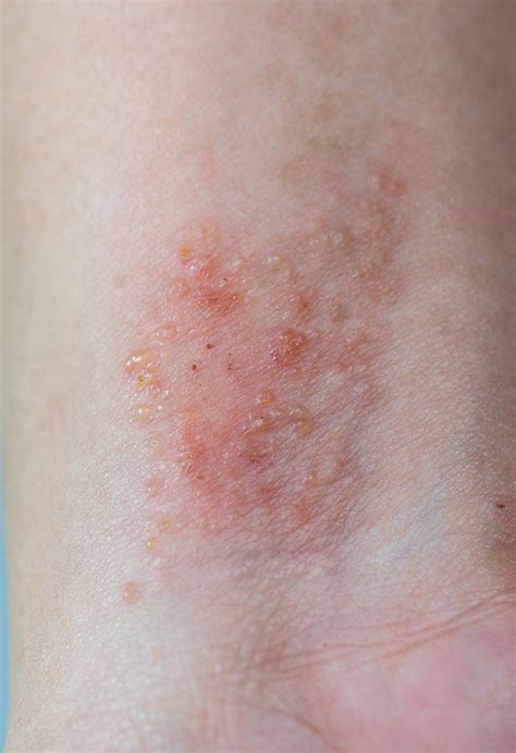 igla razjedinjenost odijelo dermatitis krema za sunčanje Žitarica ...