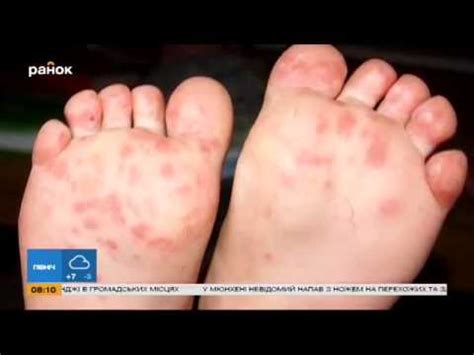 Важно. Как побороть вирус Коксаки - YouTube