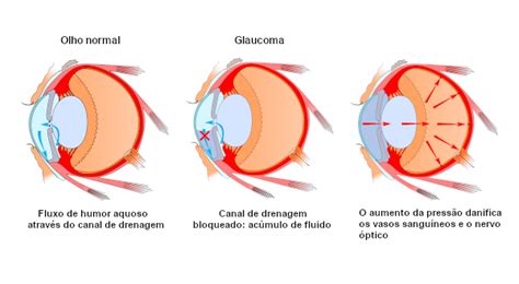 O Que Causa Glaucoma - Glaucoma: o que é, causas, tipos, sintomas, cura - Brasil Escola