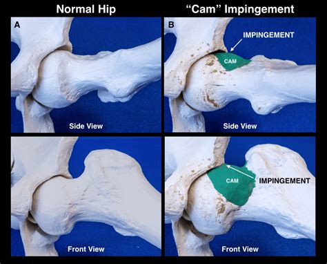 Hip Impingement Treatment | North Hollywood | Los Angeles Orthopedic ...