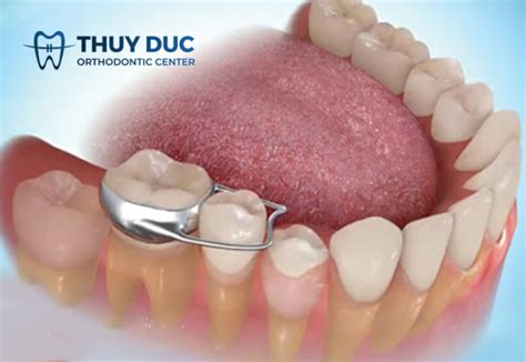 hoi dap truong hop nao nieng rang khong phai gan bands