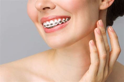 braces vivid dental archives vivid dental surgeons