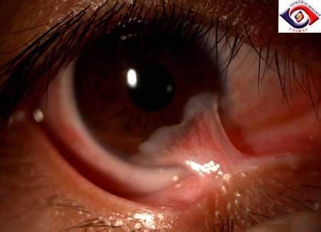SYMBLEPHARON Symblepharon is the... - Being an Optometrist