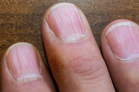 Anemia Nails