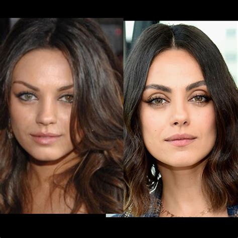 What caused this extreme upper eyelid exposure increase? She’s only 39