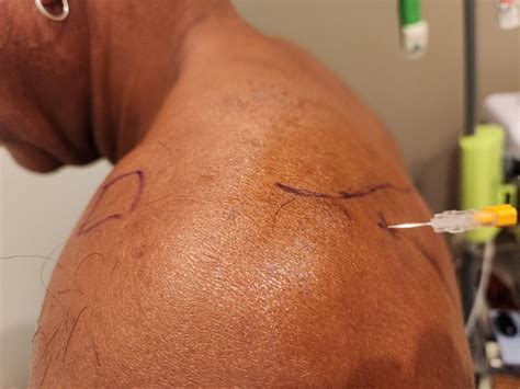 shoulder injections recharge biomedical