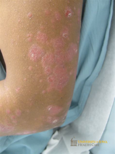 Salmon-colored scaly papules and plaques on the arm. (click images for