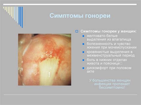Гонорея. Особенности гонореи у женщин - презентация онлайн