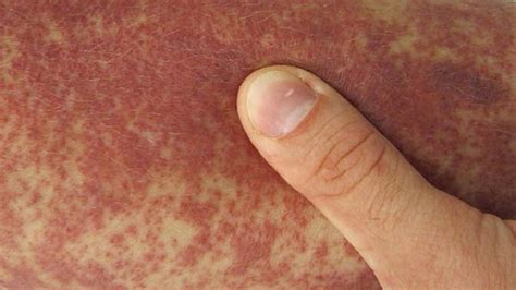 Reasons For Purpura