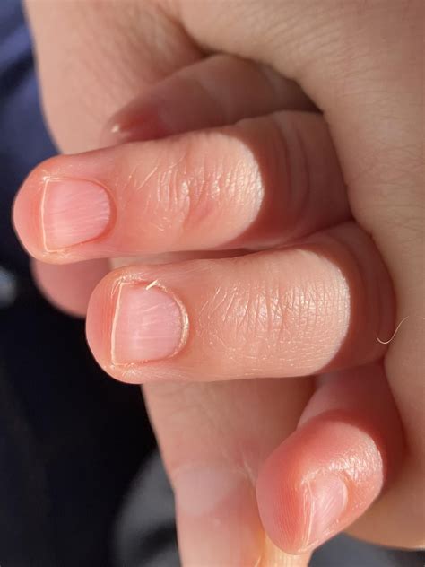 Ridges on my toddlers fingernails : r/toddlertips