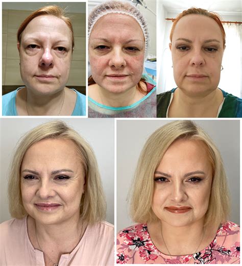 METAMORFOZA-1 | Klinika Medycyny Estetycznej - Ostrołęka, Łomża.