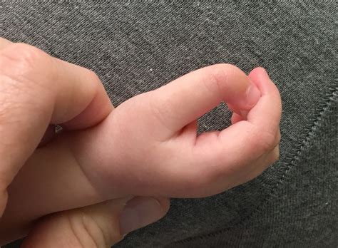 crooked thumb congenital hand  arm differences washington
