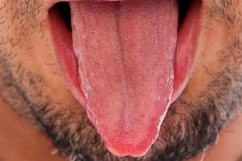 Swollen Taste Buds Causes, Getting Rid of Tip, Back Tongue Enlarged