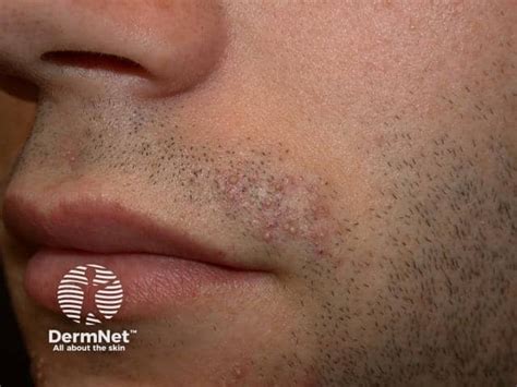 folliculitis barbae images dermnet