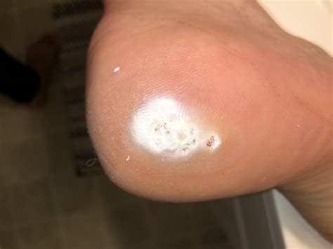Salicylic Acid For Warts How Long at Sharon Soliz blog