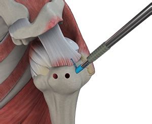 Arthroscopic Shoulder Stabilization Surgery Lincoln NE | Shoulder ...