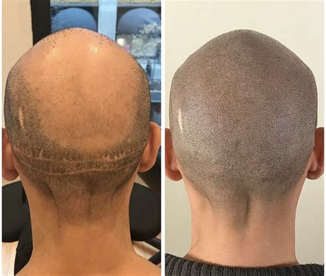 covering  hair transplant scar scalp micro usa
