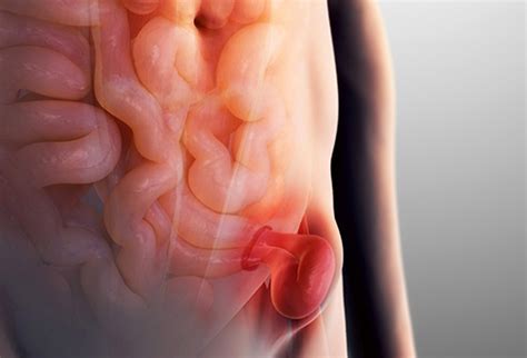 O'que É Hernia Inguinal - Hérnia Inguinal - O Que é, Sintomas, Tratamento e Cirurgia - MundoBoaForma