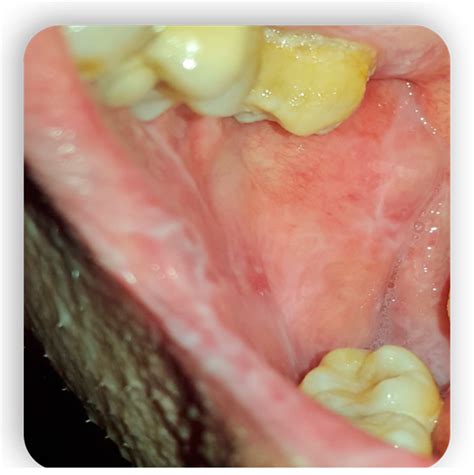 Oral Manifestations of Graft vs. Host Disease: A Comprehensive Review