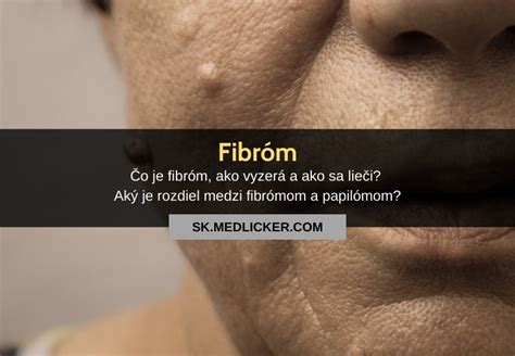 Čo je fibróm, ako vyzerá a ako sa lieči