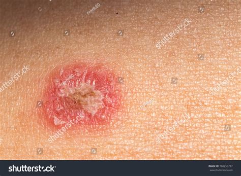 Roundworm Skin