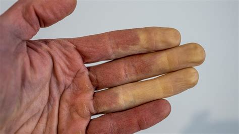 What Is Raynaud's Disease? Disorder Causes White or Blue Fingers, Toes When It's Cold