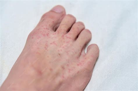 Coceira No Pé Esquerdo O Que Significa - Reação alérgica erupção cutânea com coceira no pé | Foto Premium