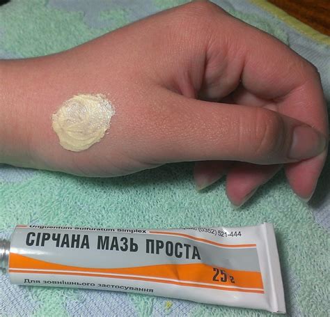 7 вопросов о том, как лечить лишай у человека в домашних условиях