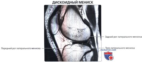 КТ, МРТ дискоидного мениска коленного сустава