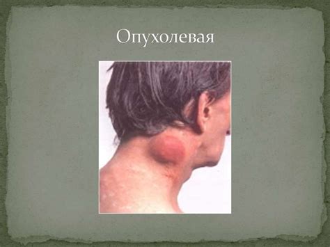 Саркома Капоши - презентация онлайн