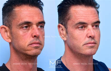 what is jowling of the face 6