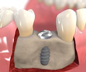 bone-graft-1 | Aspen Oral and Maxillofacial Surgery