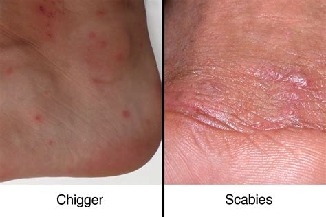 Chiggers Bites Treatment at Hannah Rowlandson blog