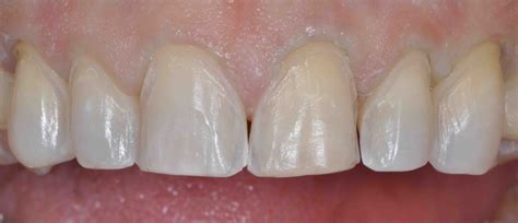 Supragingival Margins: When Do They Work? - Lee Ann Brady, DMD's Dental