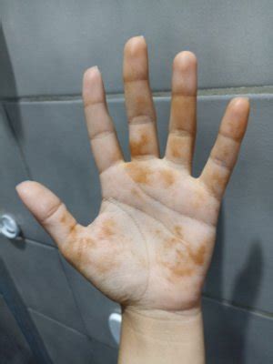 Mãos Amarela O Que Pode Ser - Mancha amarelada palma mao | BabyCenter