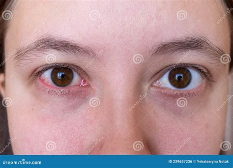 bloodshot eyes dangerous  andy sage blog