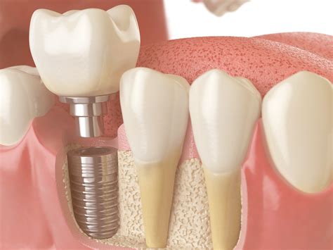 Bone Graft For Dental Implant Youtube at Bernice Hood blog