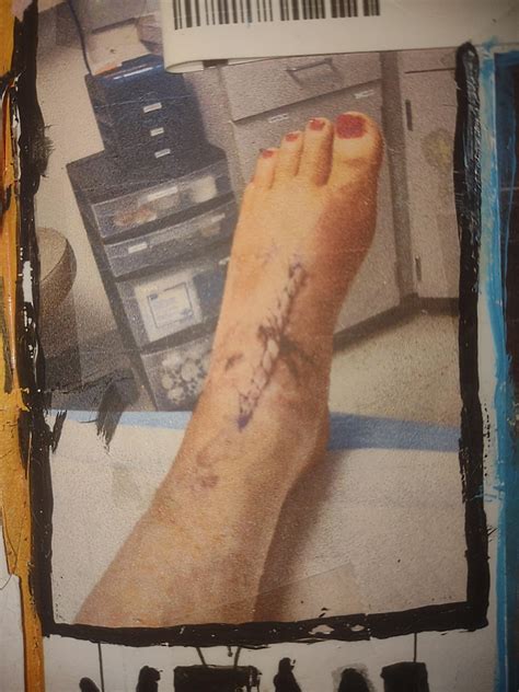 EHL Tendon Laceration (Healing Progression) : r/InjuriesAndWounds