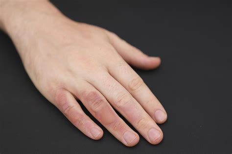 С какво да намажем изгорено? | Biotica.bg