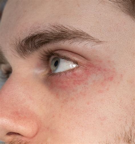 Itchy Hives Around Eyes What Is This Rash Under My Eye And How Can I