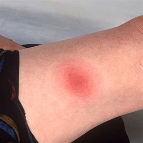 What Does A Tick Bite Look Like Health Images And Pho - vrogue.co