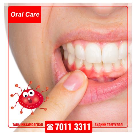 Буйлны үрэвсэлт өвчин (Gum disease or Gingivitis) гэж юу вэ?