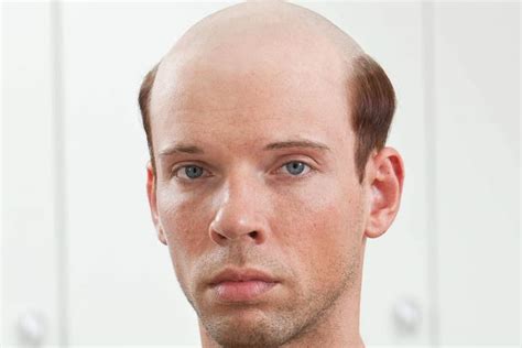 Pin by Alfred Scholz on special effect | Balding, Punishment haircut, Male pattern baldness
