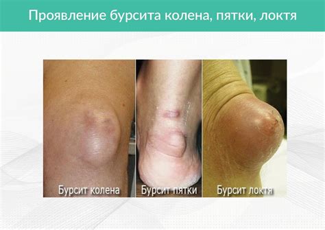 Бурсит - Лечение в Москве | Clinic